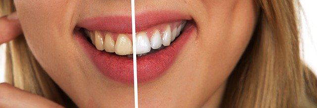 zahnpflege - Zahnverfärbungen und Gegenmittel